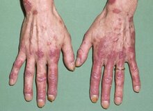 لوپوس در کودکان خطرناک‌تر و پیشرونده‌تر است