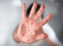 آیا احتمال انتقال آبله میمونی از هوا وجود دارد؟!
