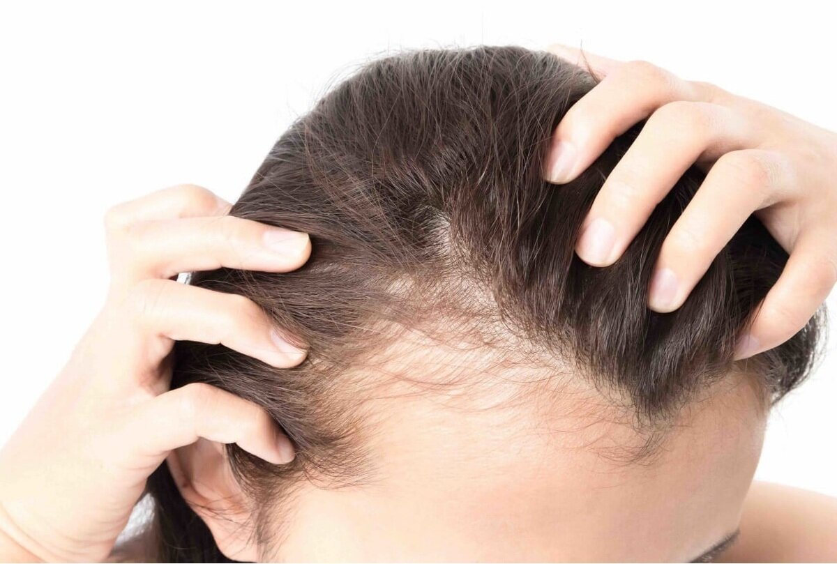 چهار توصیه مهم برای کسانی که ریزش مو دارند