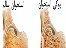 پوکی استخوان عامل ۴۲۰۰ مرگ سالانه در کشور 