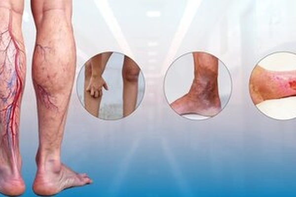 خطرات واریس پا: از زخم های مزمن تا آمبولی ریه