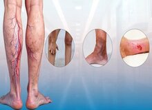 خطرات واریس پا: از زخم های مزمن تا آمبولی ریه