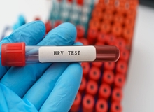 قیمت‌های نجومی، آزمایش HPV را از سبد سلامت مردم حذف کرد
