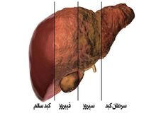 دلایل اصلی‌ بیماری کبد چرب چیست؟