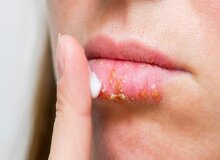 ۴ دلیل ترک خوردن لب‌ها+ روش‌های درمان