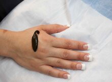 متخصصان طب سنتی: زالو درمانی هم خوب است،هم قانونی است هم پیروی از طب ابوعلی سینا/ بیماران صدمه دیده: هم هزینه فراوان دادیم، هم بیماری تشدید شد