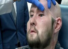 نخستین پیوند چشم کامل انسان توسط جراحان آمریکایی انجام شد