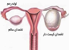 داروهای خانگی برای کیست های تخمدان