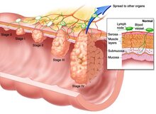 استفاده از چای داغ، آمار مبتلایان به سرطان مری را افزایش می‌دهد