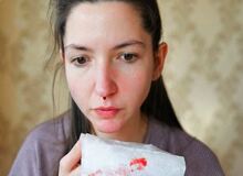 چگونه خون دماغ را بند بیاوریم؟