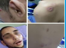 جزئیات شکنجه یک معلول در قائمشهر/ فرزندم را با آثار سوختگی و زخم ترخیص کردم