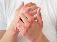 بیماری پسوریازیس و چه علائمی دارد؟