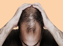 ۲۰ خوراکی برای جلوگیری از ریزش مو