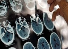 راهکار مؤثر برای پیشگیری از فراموشی و آلزایمر