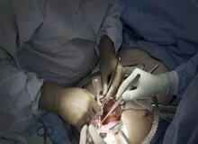 پیوند کلیه خوک به انسان+ عکس 