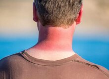 آفتاب‌سوختگی را چطور درمان کنیم؟