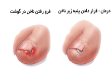 وقتی ناخن پا در گوشت فرو می رود