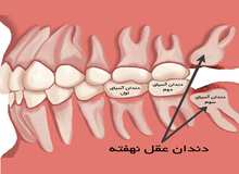 دندان عقل را بی دلیل نکشید