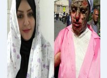 آخرین وضعیت درمانی معصومه/ «اسید» تمام نسوج عمقی سر و صورت او را سوزانده است
