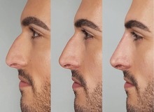 انجام عمل جراحی بینی برای این ۱۹ گروه بسیار خطرناک است