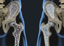 با این روش از ابتلا به پوکی استخوان فرار کنید