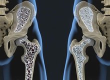 با این روش از ابتلا به پوکی استخوان فرار کنید